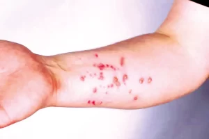 Secretaria de Saúde descarta caso de monkeypox em paciente potiguar